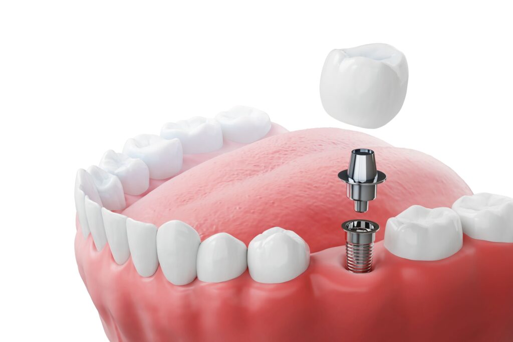 Rendering of a dental implant in a lower arch with a white background